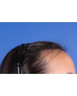 Before Hair Transplant&nbsp;Hairline
